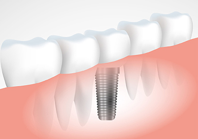 implantes